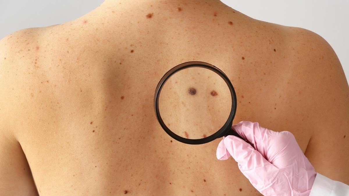 Prevenzione melanoma, nuova Giornata nazionale con attività anche nelle scuole  - 